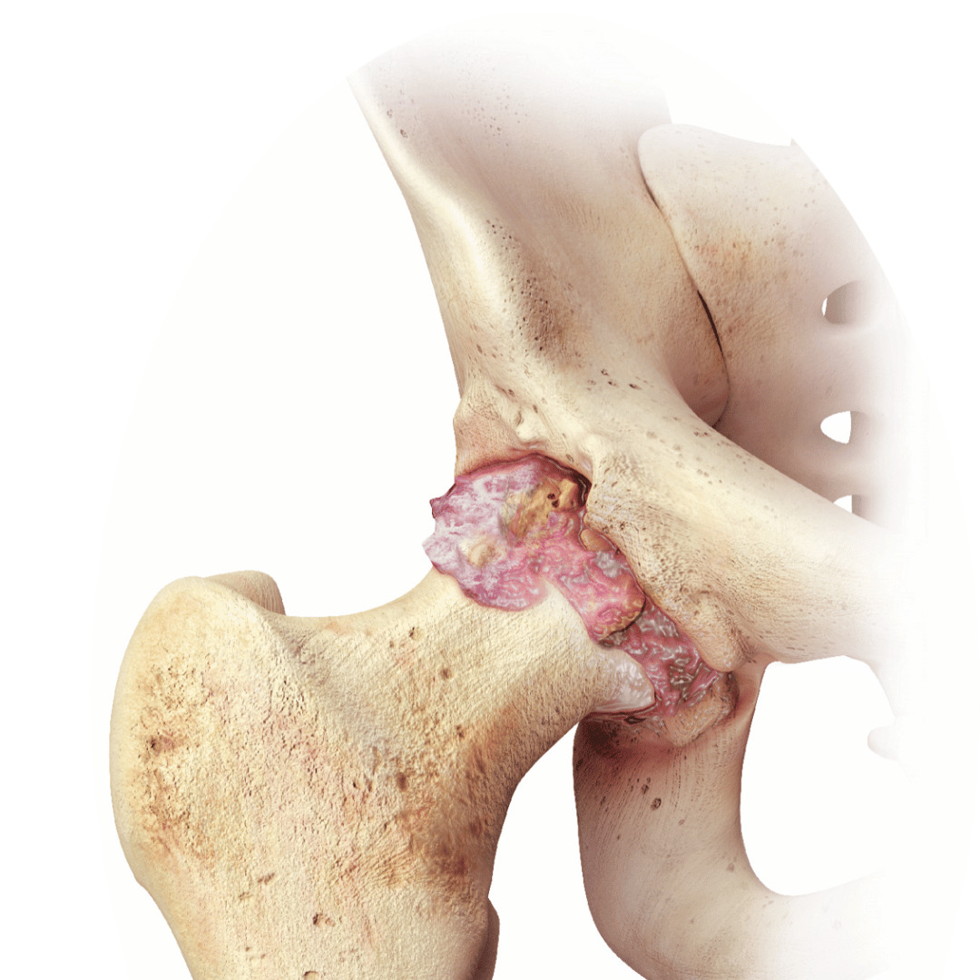 Total Hip Replacement