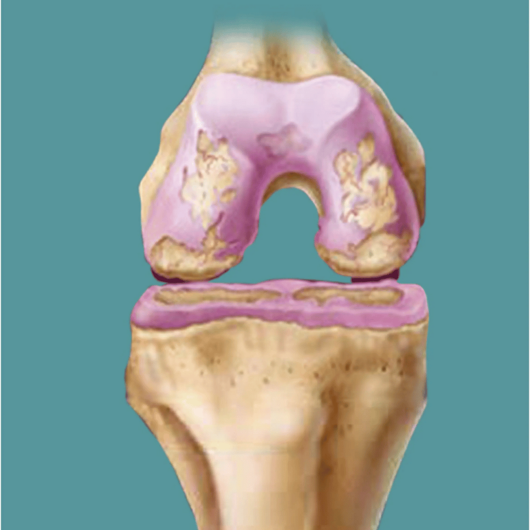 Total Knee Replacement