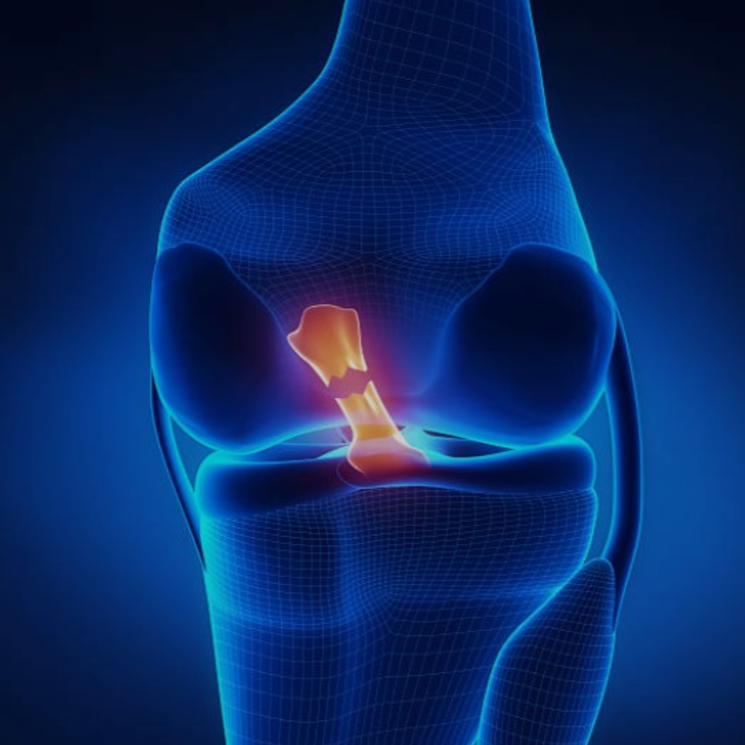 Knee Meniscus, Ligament Injuries