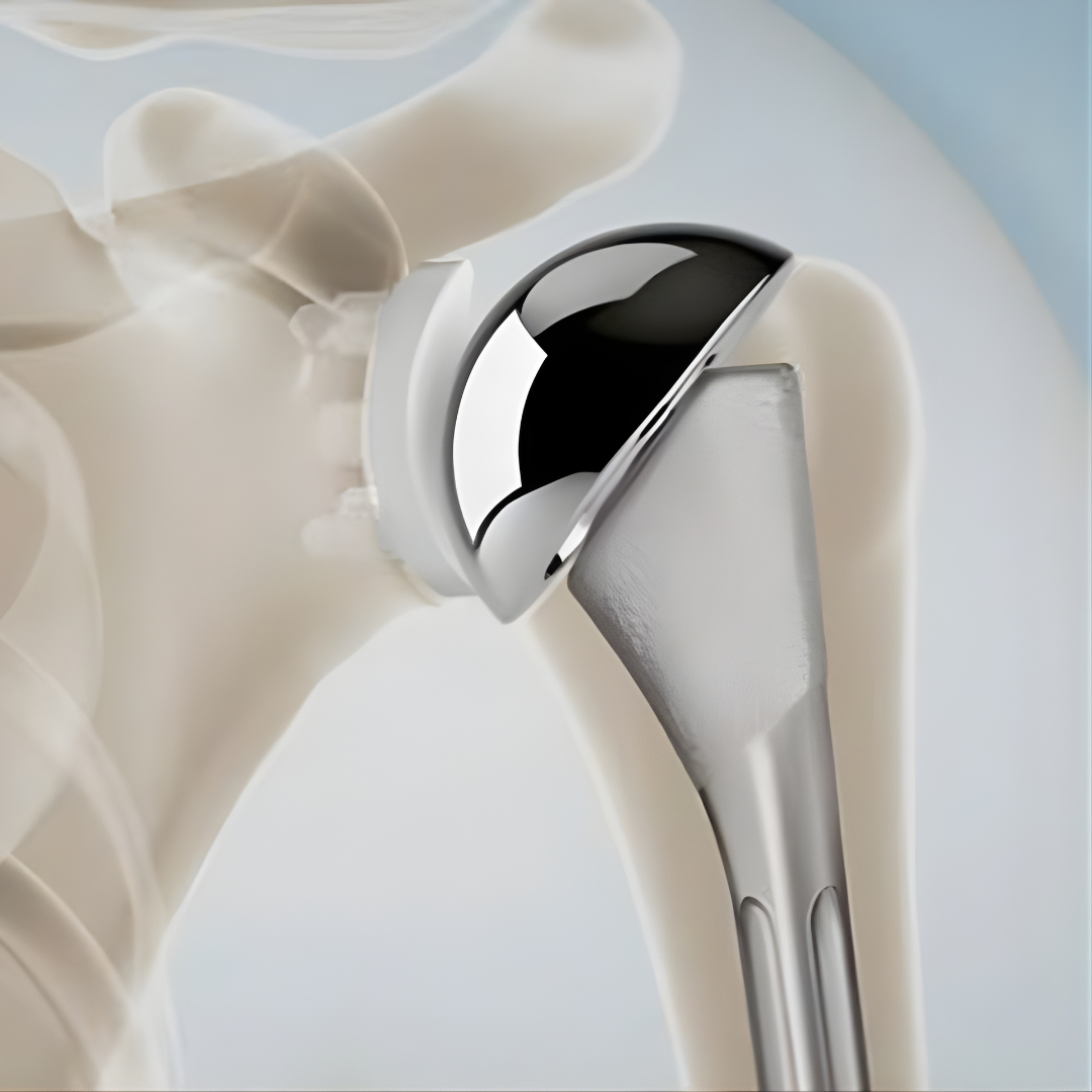 Total and Reverse Shoulder Replacement