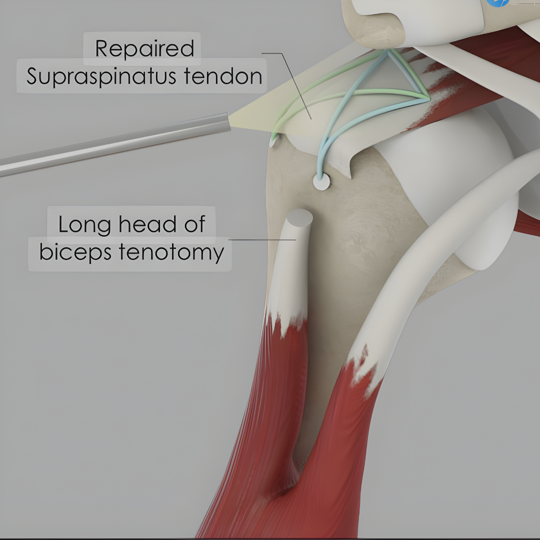Shoulder Rotator Cuff Tear, Biceps Tear